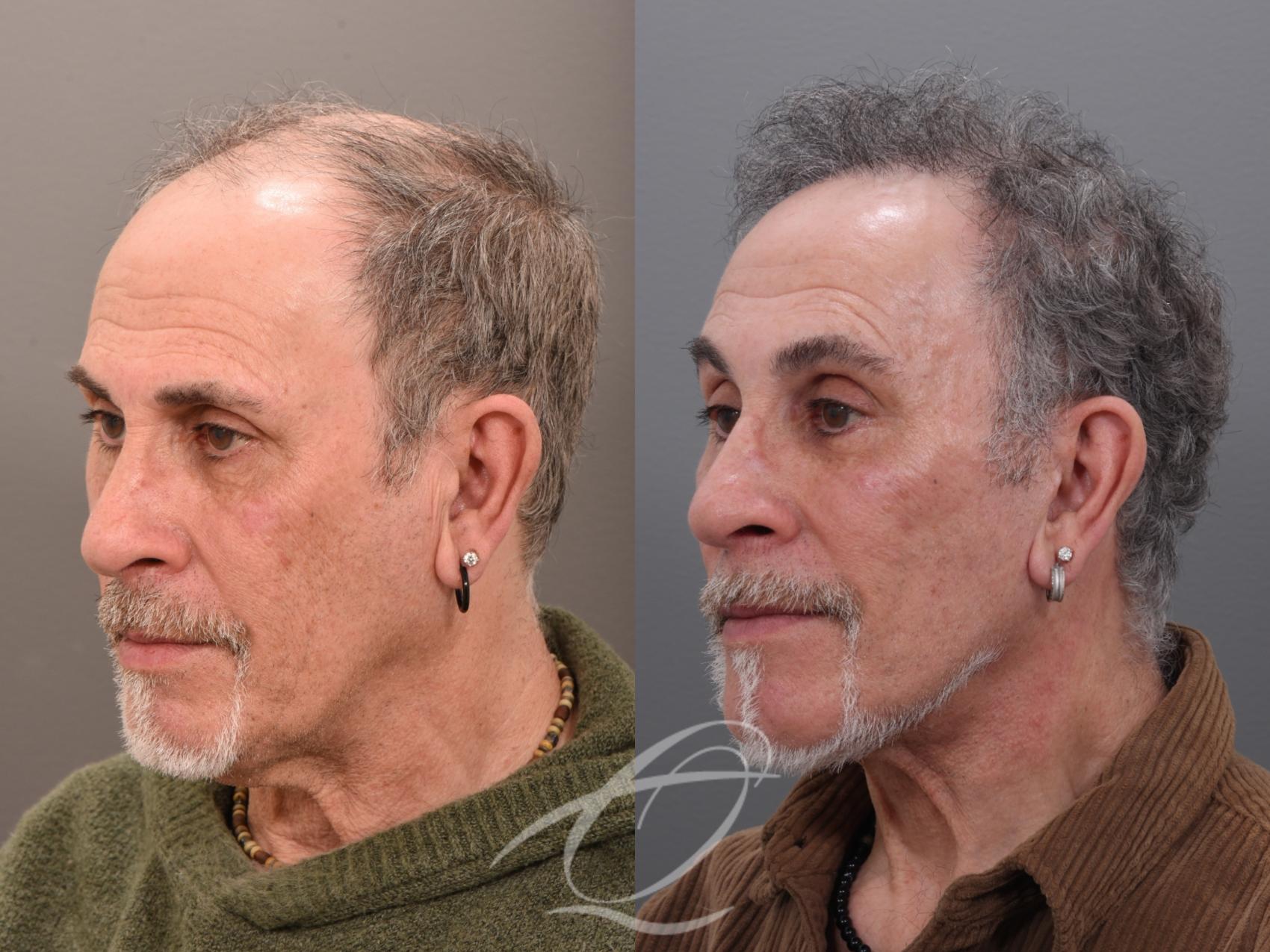 Male Facelift Case 1002045 Before & After Left Oblique | Serving Rochester, Syracuse & Buffalo, NY | Quatela Center for Plastic Surgery