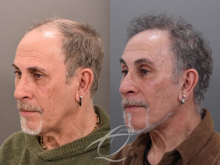 Male Facelift Case 1002045 Before & After Left Oblique | Serving Rochester, Syracuse & Buffalo, NY | Quatela Center for Plastic Surgery