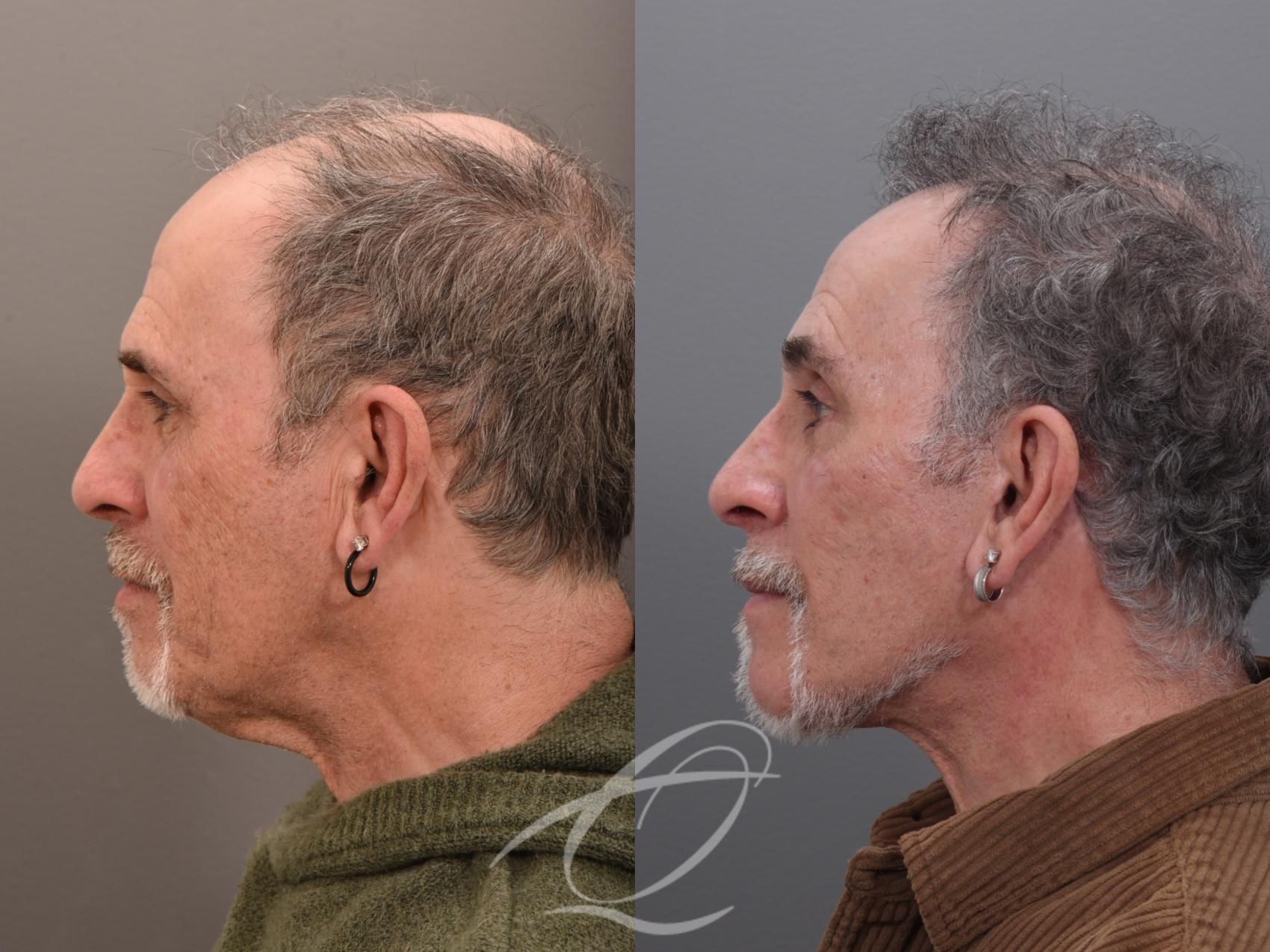 Male Facelift Case 1002045 Before & After Left Side | Serving Rochester, Syracuse & Buffalo, NY | Quatela Center for Plastic Surgery