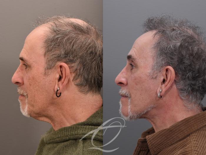 Male Facelift Case 1002045 Before & After Left Side | Serving Rochester, Syracuse & Buffalo, NY | Quatela Center for Plastic Surgery