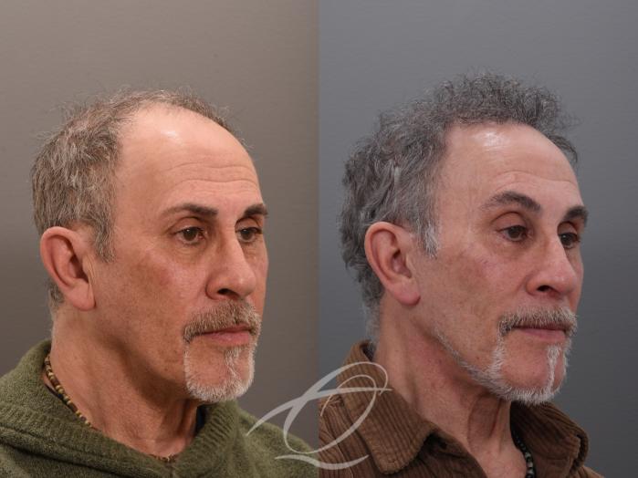 Male Facelift Case 1002045 Before & After Right Oblique | Serving Rochester, Syracuse & Buffalo, NY | Quatela Center for Plastic Surgery