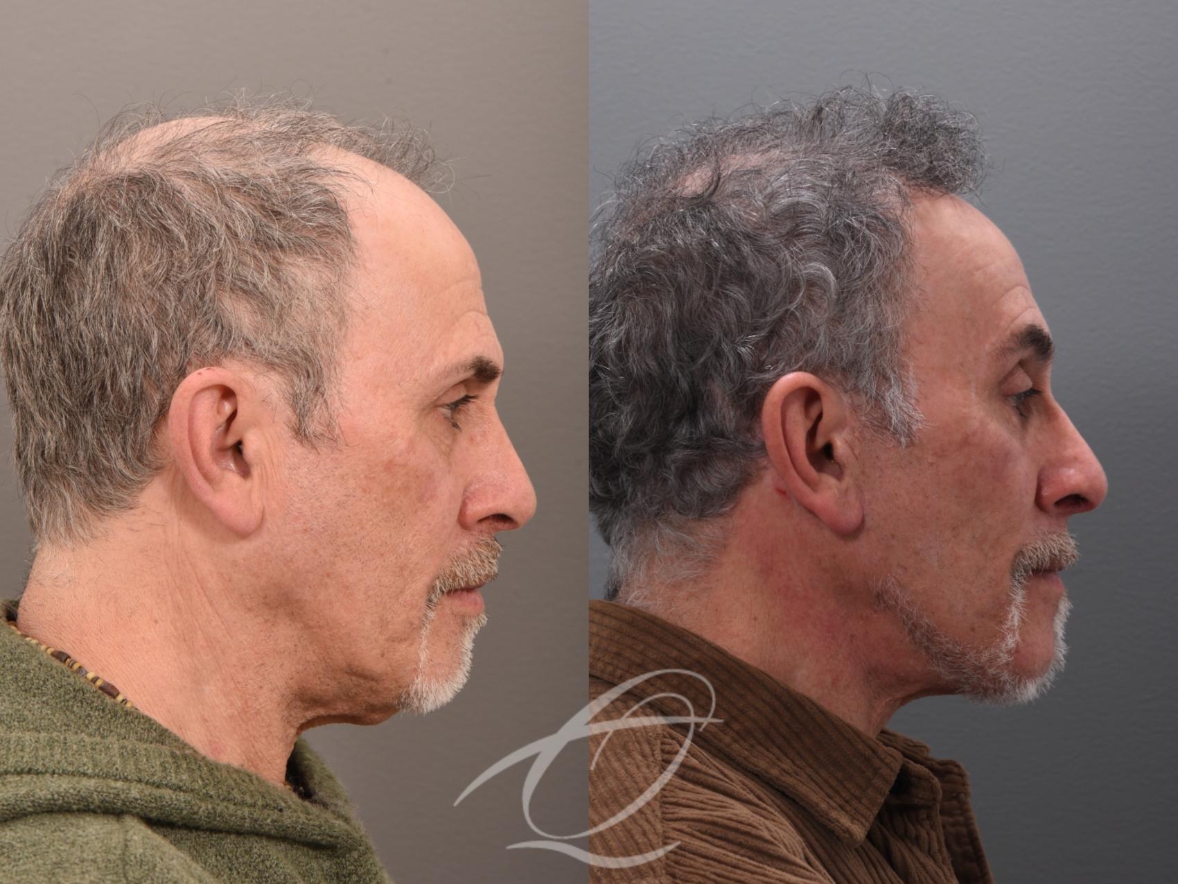 Male Facelift Case 1002045 Before & After Right Side | Serving Rochester, Syracuse & Buffalo, NY | Quatela Center for Plastic Surgery