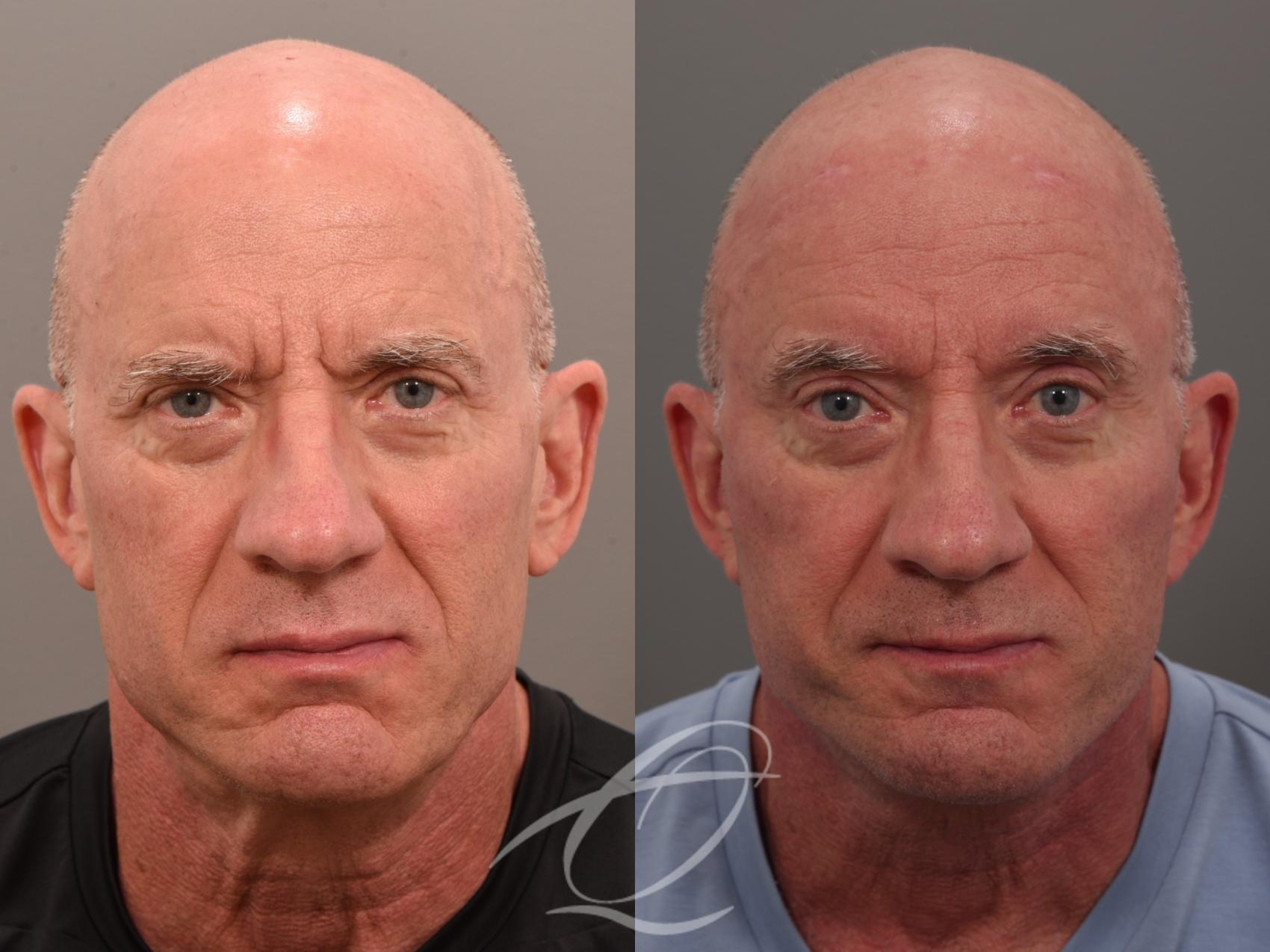 Male Facelift Case 1002049 Before & After Front | Serving Rochester, Syracuse & Buffalo, NY | Quatela Center for Plastic Surgery