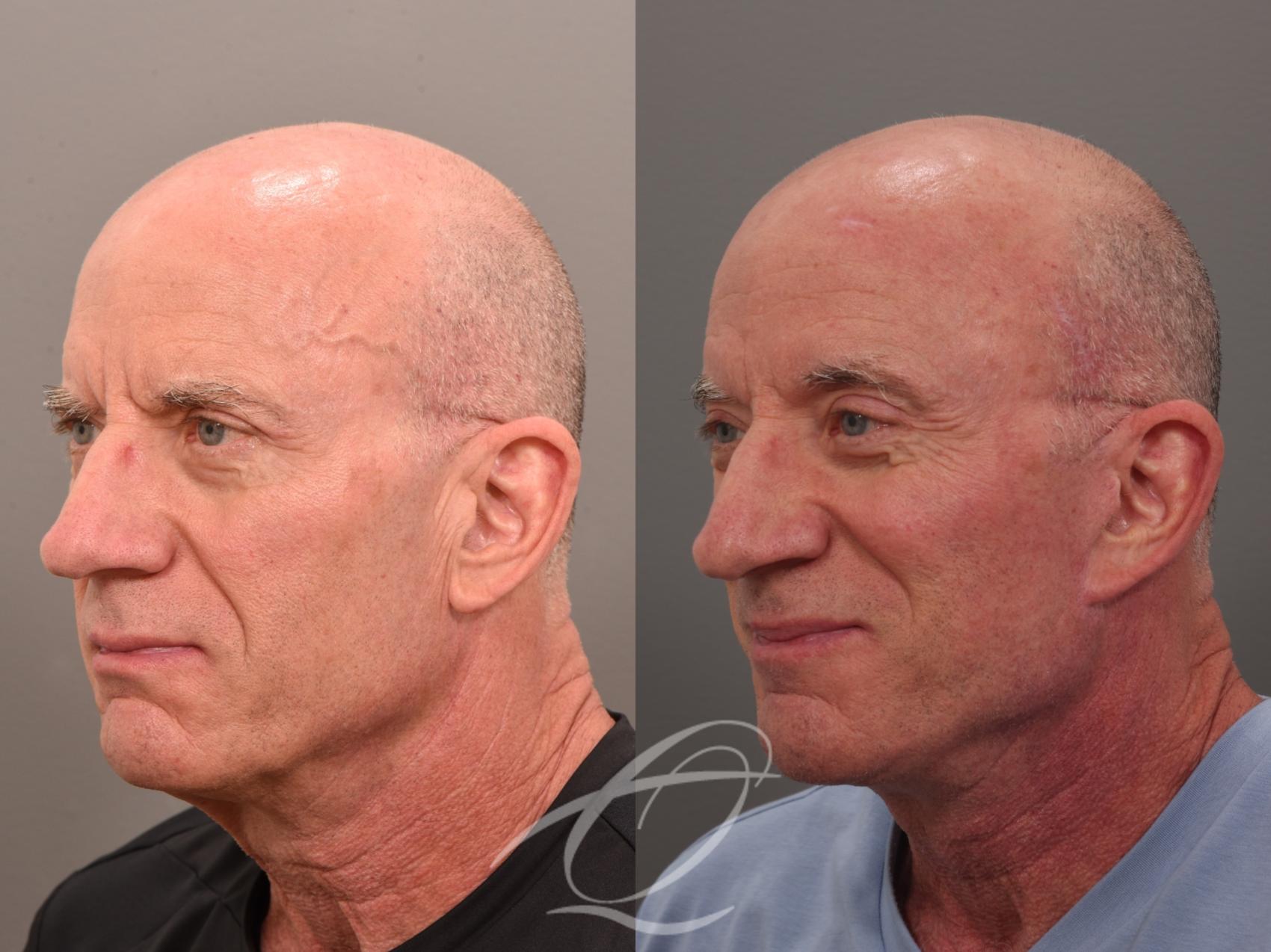 Male Facelift Case 1002049 Before & After Left Oblique | Serving Rochester, Syracuse & Buffalo, NY | Quatela Center for Plastic Surgery