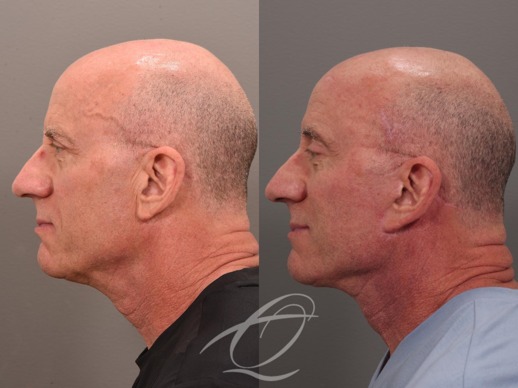 Male Facelift Case 1002049 Before & After Left Side | Serving Rochester, Syracuse & Buffalo, NY | Quatela Center for Plastic Surgery
