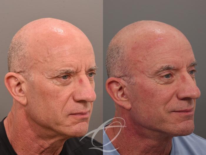 Male Facelift Case 1002049 Before & After Right Oblique | Serving Rochester, Syracuse & Buffalo, NY | Quatela Center for Plastic Surgery
