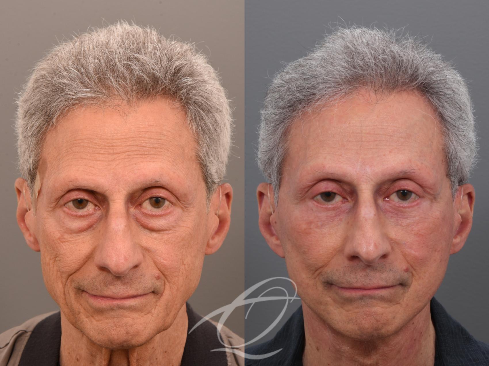 Male Facelift Case 1002073 Before & After Front | Serving Rochester, Syracuse & Buffalo, NY | Quatela Center for Plastic Surgery