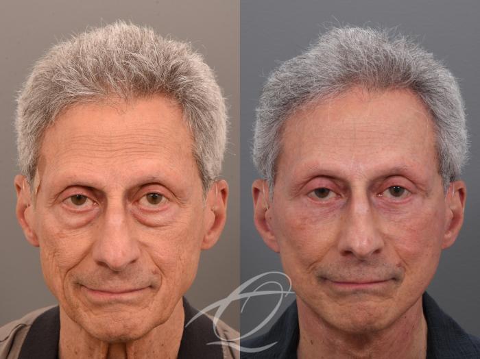 Male Facelift Case 1002073 Before & After Front | Serving Rochester, Syracuse & Buffalo, NY | Quatela Center for Plastic Surgery