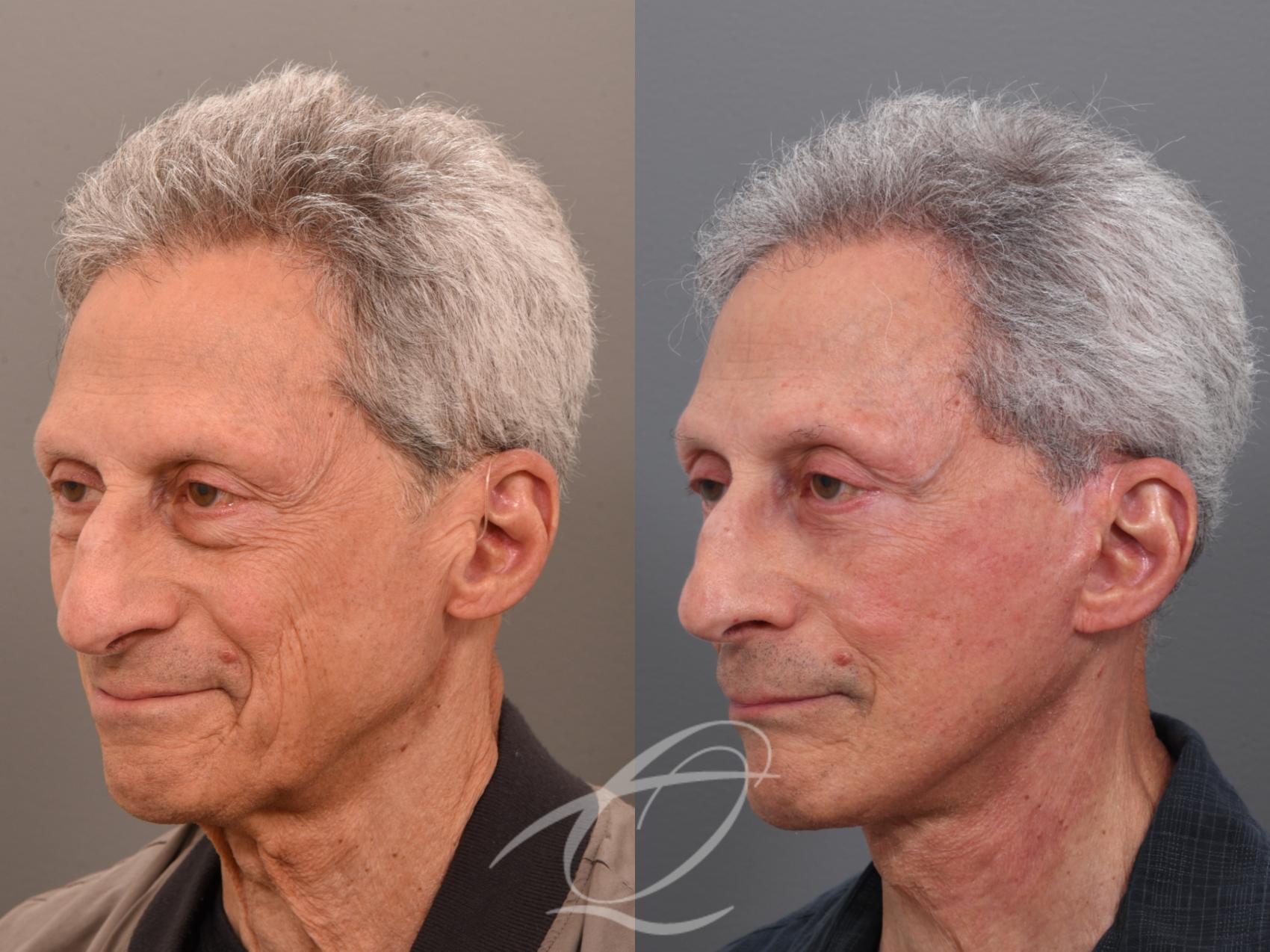 Male Facelift Case 1002073 Before & After Left Oblique | Serving Rochester, Syracuse & Buffalo, NY | Quatela Center for Plastic Surgery