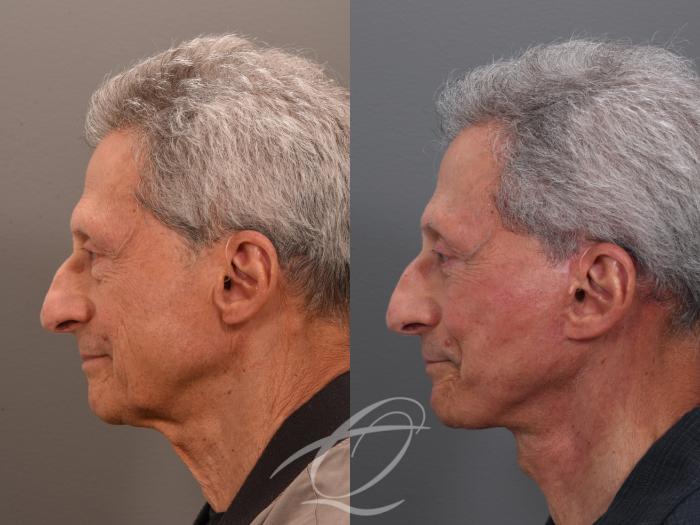 Male Facelift Case 1002073 Before & After Left Side | Serving Rochester, Syracuse & Buffalo, NY | Quatela Center for Plastic Surgery