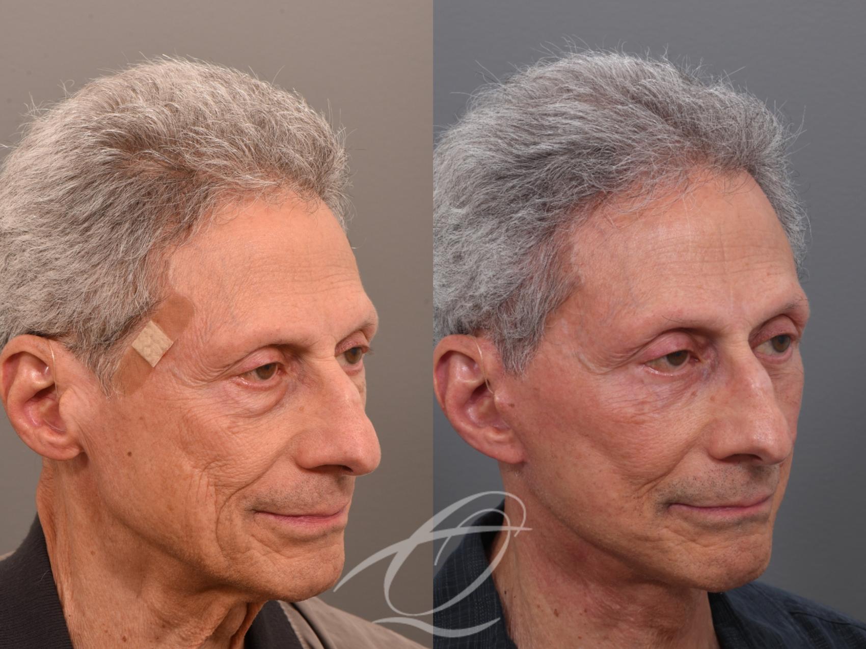 Male Facelift Case 1002073 Before & After Right Oblique | Serving Rochester, Syracuse & Buffalo, NY | Quatela Center for Plastic Surgery
