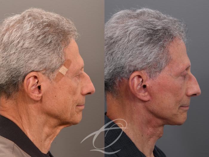 Male Facelift Case 1002073 Before & After Right Side | Serving Rochester, Syracuse & Buffalo, NY | Quatela Center for Plastic Surgery