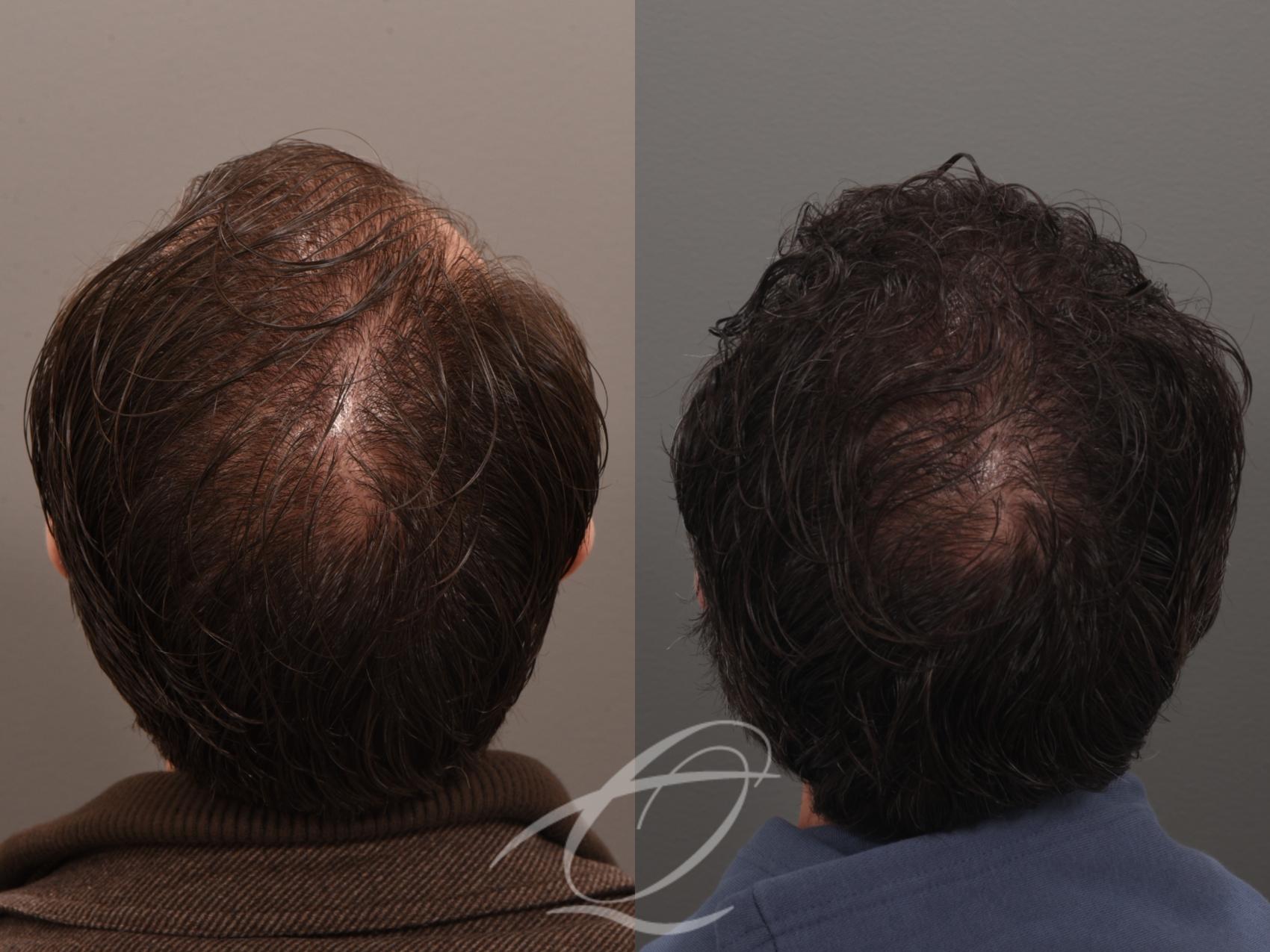 Male Facelift Case 1002074 Before & After Back | Serving Rochester, Syracuse & Buffalo, NY | Quatela Center for Plastic Surgery