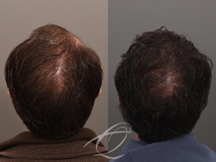 Male Facelift Case 1002074 Before & After Back | Serving Rochester, Syracuse & Buffalo, NY | Quatela Center for Plastic Surgery