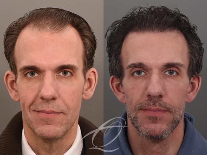 Male Facelift Case 1002074 Before & After Front | Serving Rochester, Syracuse & Buffalo, NY | Quatela Center for Plastic Surgery