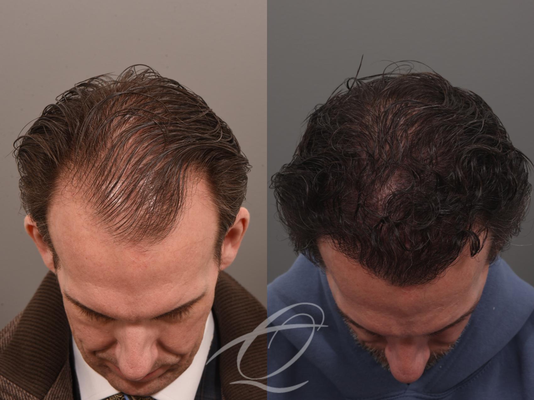 Male Facelift Case 1002074 Before & After Hairline | Serving Rochester, Syracuse & Buffalo, NY | Quatela Center for Plastic Surgery