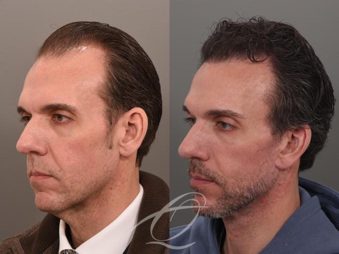 Male Facelift Case 1002074 Before & After Left Oblique | Serving Rochester, Syracuse & Buffalo, NY | Quatela Center for Plastic Surgery