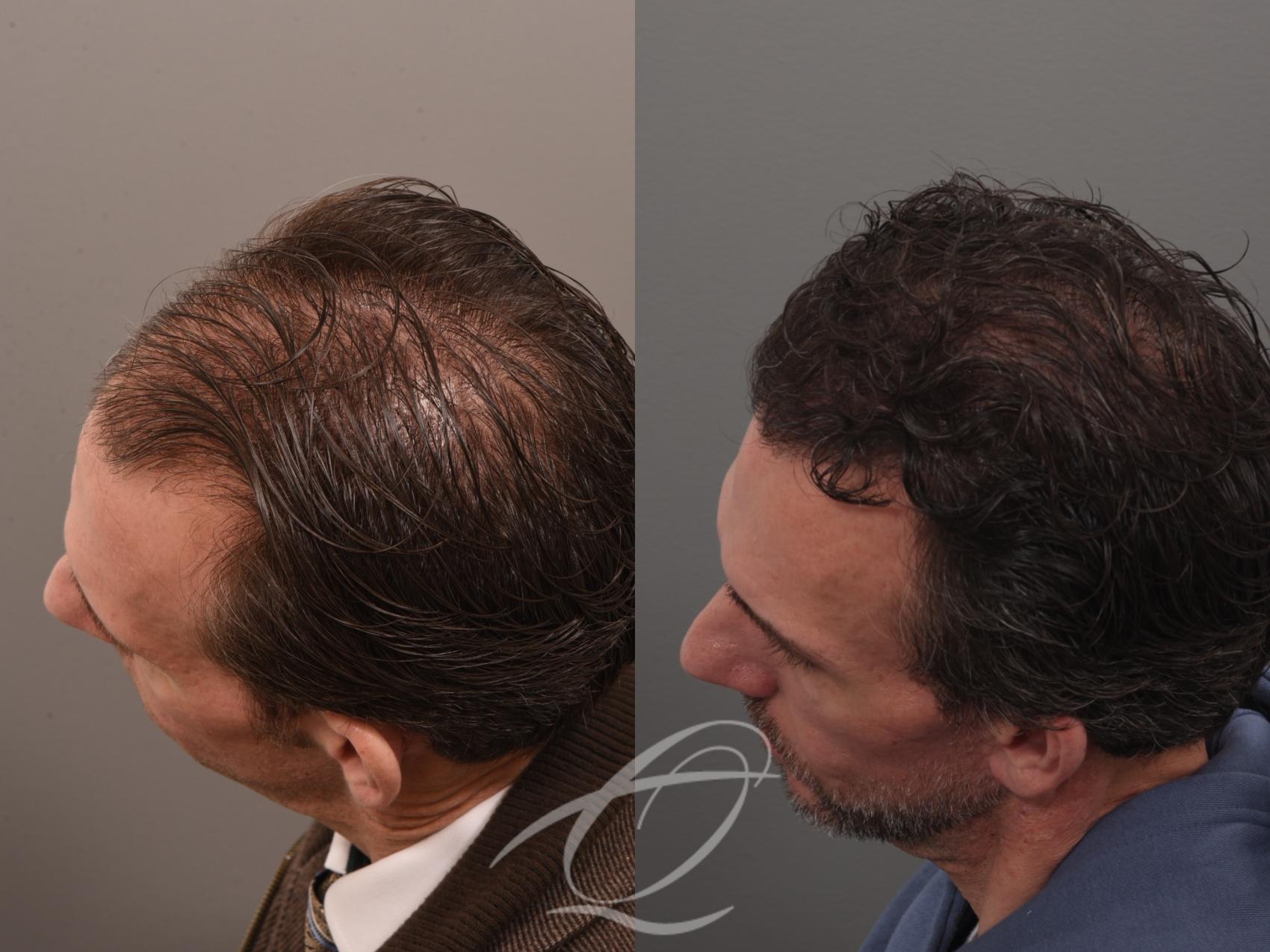 Male Facelift Case 1002074 Before & After Left Side 2 | Serving Rochester, Syracuse & Buffalo, NY | Quatela Center for Plastic Surgery