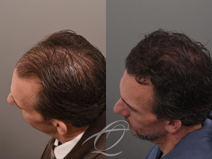 Male Facelift Case 1002074 Before & After Left Side 2 | Serving Rochester, Syracuse & Buffalo, NY | Quatela Center for Plastic Surgery