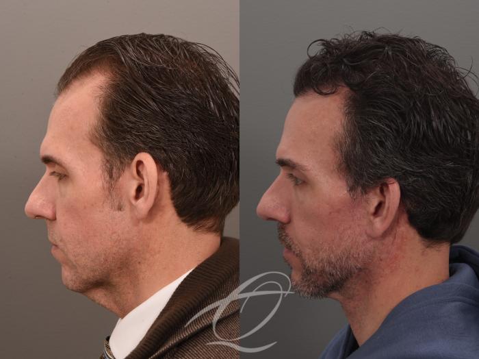 Male Facelift Case 1002074 Before & After Left Side | Serving Rochester, Syracuse & Buffalo, NY | Quatela Center for Plastic Surgery