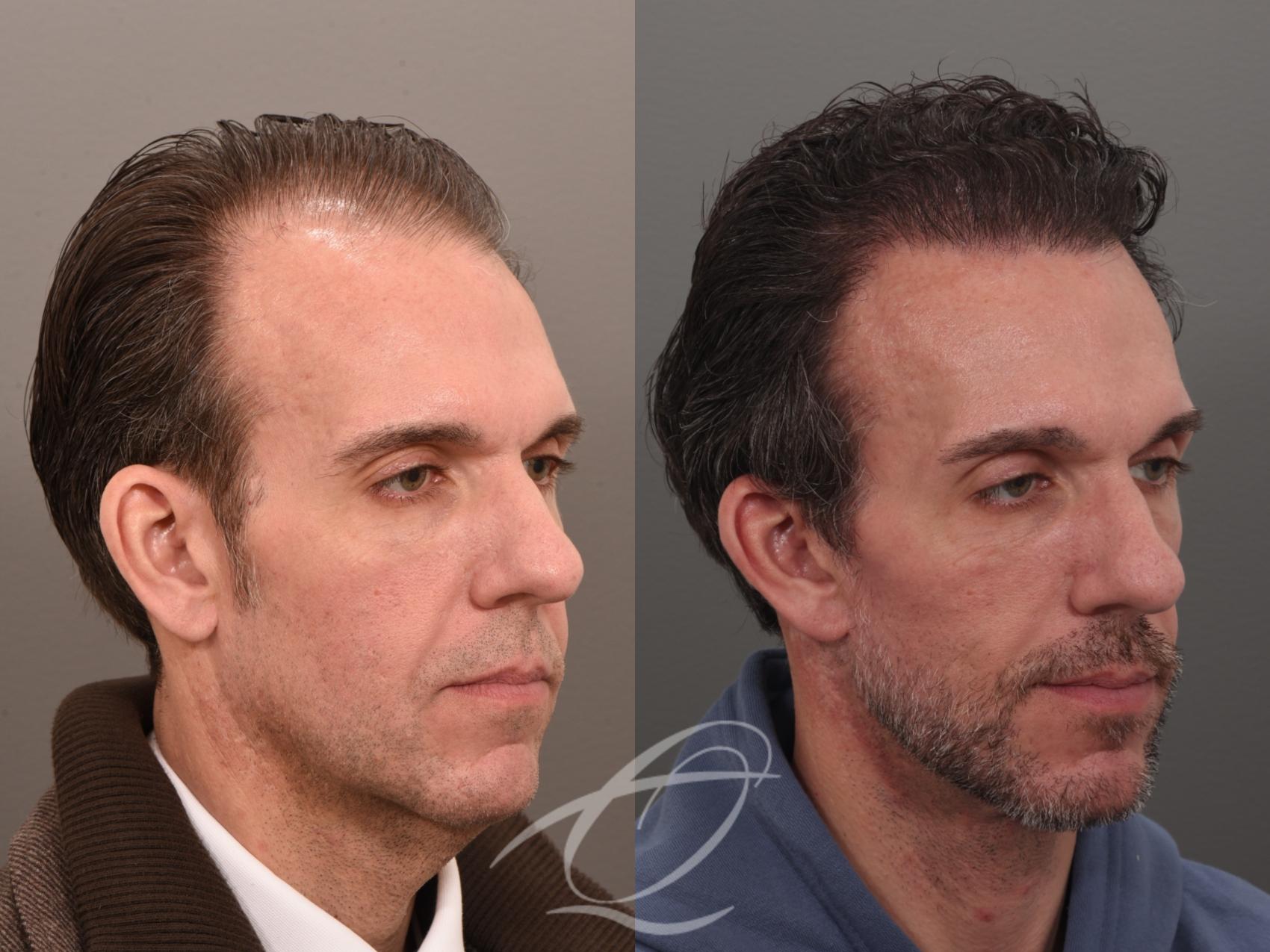 Male Facelift Case 1002074 Before & After Right Oblique | Serving Rochester, Syracuse & Buffalo, NY | Quatela Center for Plastic Surgery