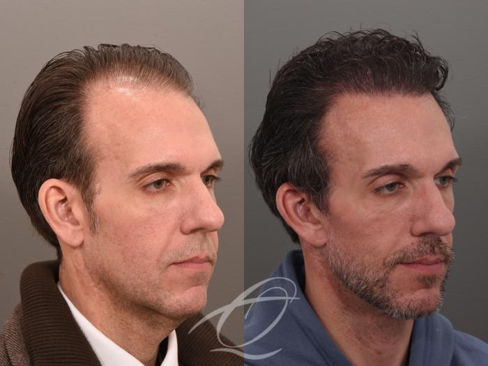 Male Facelift Case 1002074 Before & After Right Oblique | Serving Rochester, Syracuse & Buffalo, NY | Quatela Center for Plastic Surgery