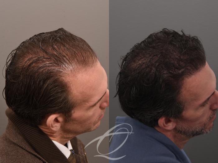 Male Facelift Case 1002074 Before & After Right side 2 | Serving Rochester, Syracuse & Buffalo, NY | Quatela Center for Plastic Surgery