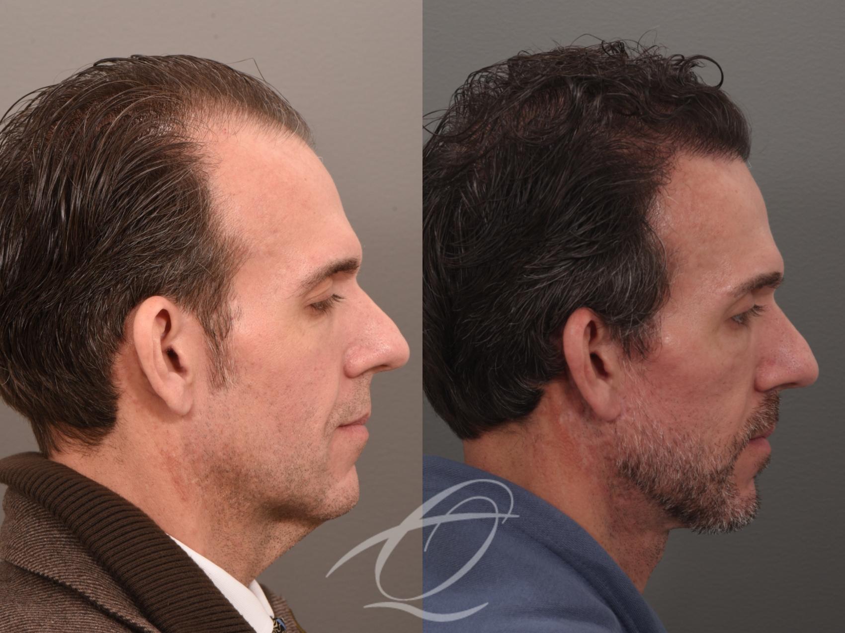 Male Facelift Case 1002074 Before & After Right Side | Serving Rochester, Syracuse & Buffalo, NY | Quatela Center for Plastic Surgery