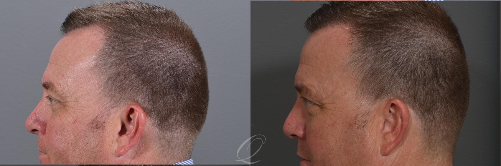 Male FUE Hair Transplant Case 1001522 Before & After Left Side | Rochester, Buffalo, & Syracuse, NY | Quatela Center for Hair Restoration