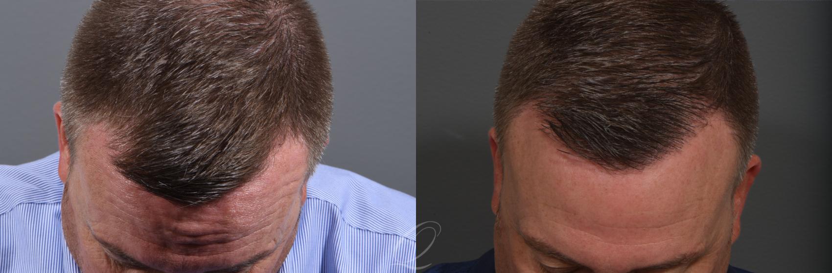 Male FUE Hair Transplant Case 1001522 Before & After Top Down | Rochester, Buffalo, & Syracuse, NY | Quatela Center for Hair Restoration