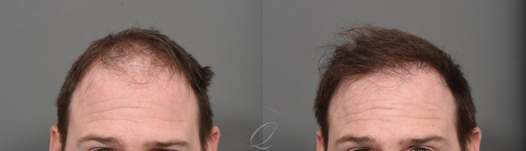 Male Hairline and Central Density Hair Restoration Case 1001523 Before & After Front | Rochester, Buffalo, & Syracuse, NY | Quatela Center for Hair Restoration