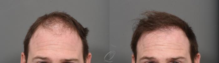 Male FUE Hair Transplant Case 1001523 Before & After Front | Rochester, Buffalo, & Syracuse, NY | Quatela Center for Hair Restoration