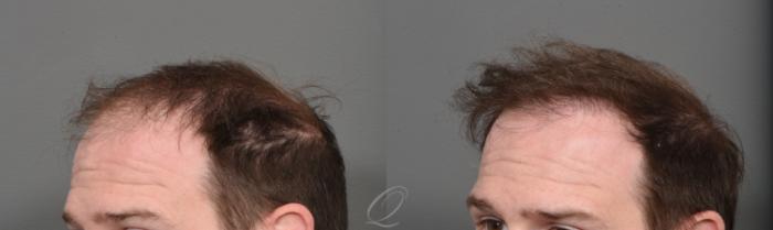 Male FUE Hair Transplant Case 1001523 Before & After Left Oblique | Rochester, Buffalo, & Syracuse, NY | Quatela Center for Hair Restoration