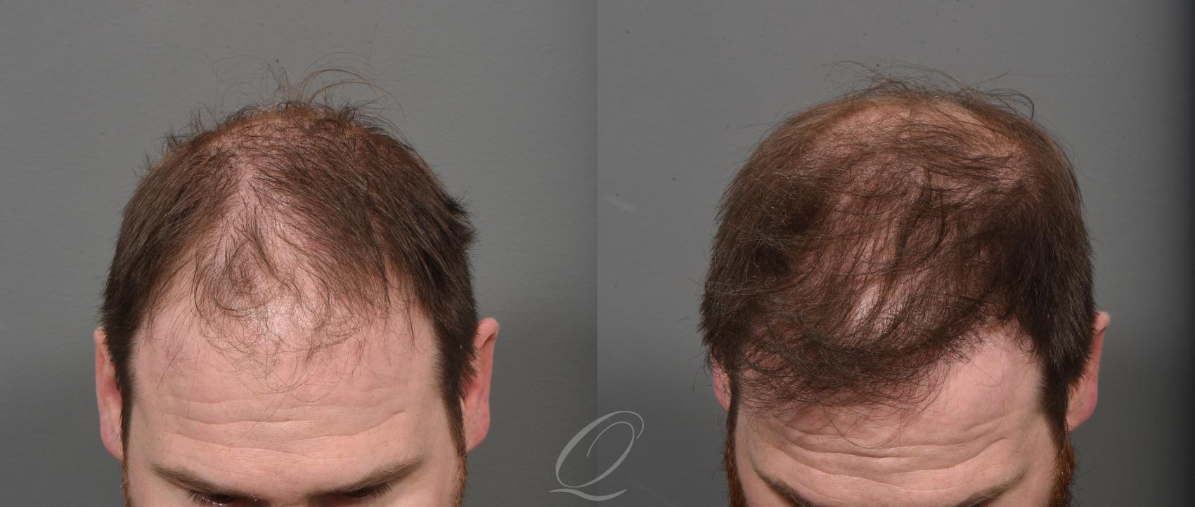Male FUE Hair Transplant Case 1001523 Before & After Top Down | Rochester, Buffalo, & Syracuse, NY | Quatela Center for Hair Restoration