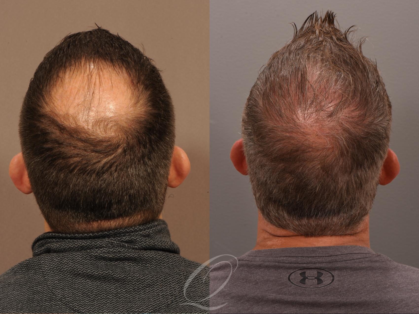 Male FUE Hair Transplant Before After Photos Patient 1001537 