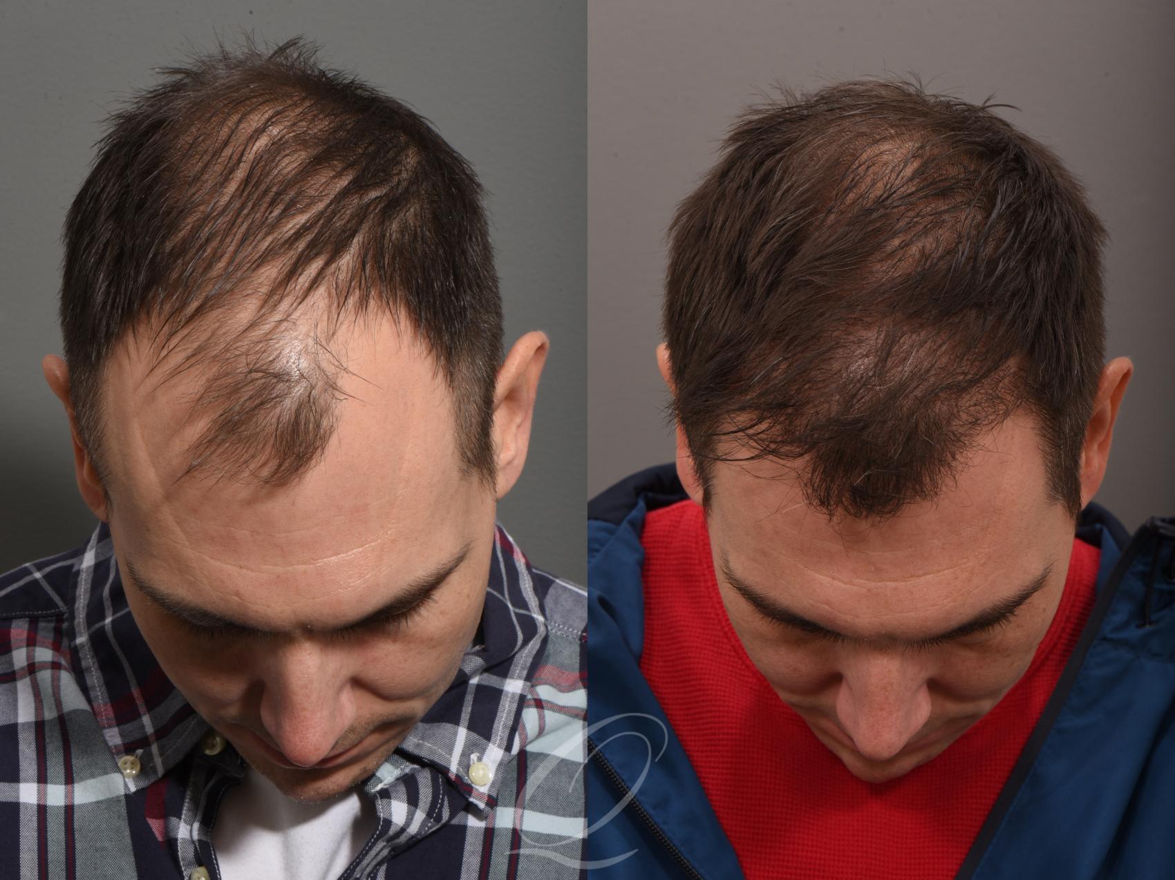 Scarless Hair Transplant in Rochester NY | FUE | Quatela Center for Hair  Restoration