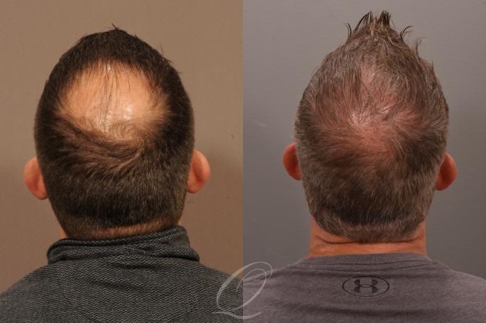 Male Crown Hair Restoration Before And After Photo Gallery Serving