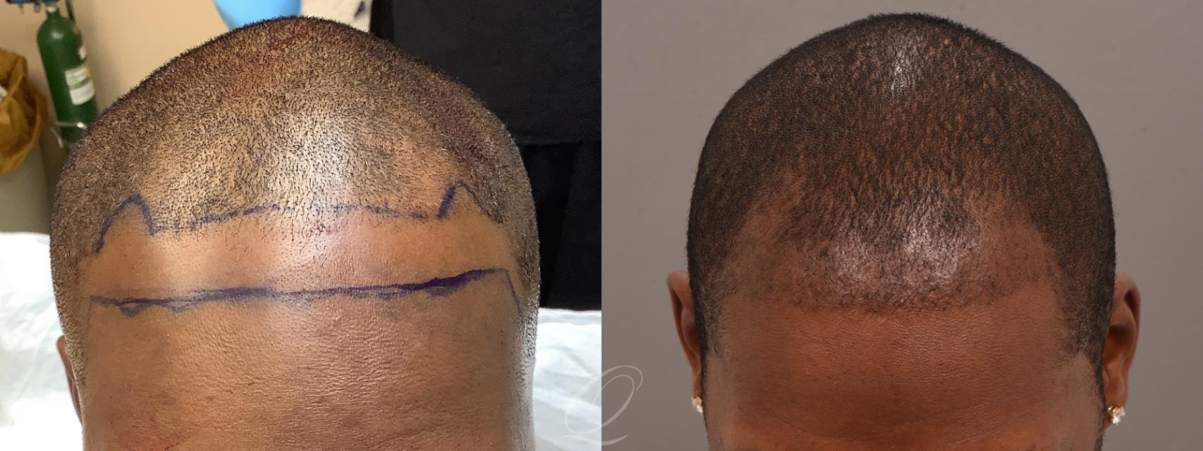 Male Fue Hair Transplant Before And After Photos Patient 1001683 Rochester Buffalo And Syracuse 