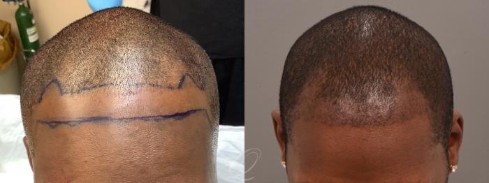 Male FUE Hair Transplant Case 1001683 Before & After Hairline | Serving Rochester, Syracuse & Buffalo, NY | Quatela Center for Plastic Surgery