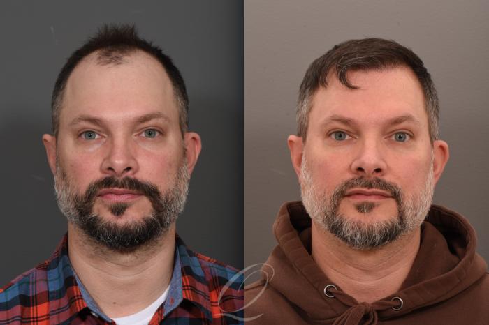 Before & After Male FUE Hair Transplant Case 1001686 Additional Front View View in Rochester, Buffalo, & Syracuse, NY