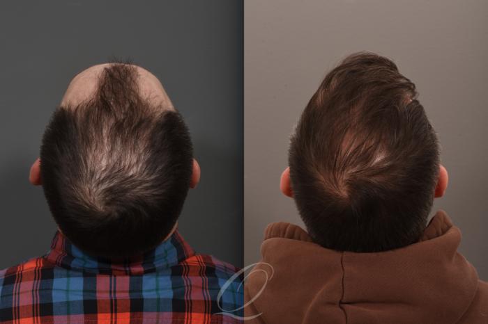 Male Hairline and Central Density Hair Restoration Case 1001686 Before & After Back Angled | Serving Rochester, Syracuse & Buffalo, NY | Quatela Center for Plastic Surgery