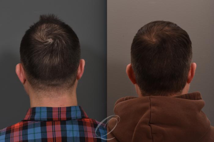 Before & After Male FUE Hair Transplant Case 1001686 Back View in Rochester, Buffalo, & Syracuse, NY
