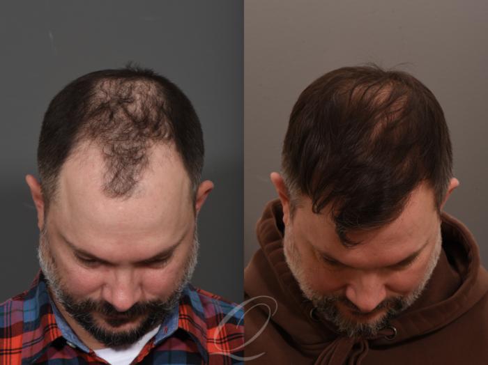 Before & After Male FUE Hair Transplant Case 1001686 Front View in Rochester, Buffalo, & Syracuse, NY