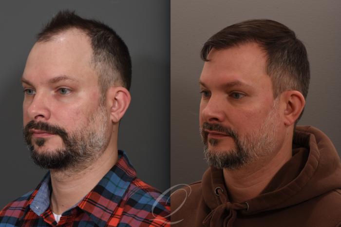 Before & After Male FUE Hair Transplant Case 1001686 Left Oblique View in Rochester, Buffalo, & Syracuse, NY