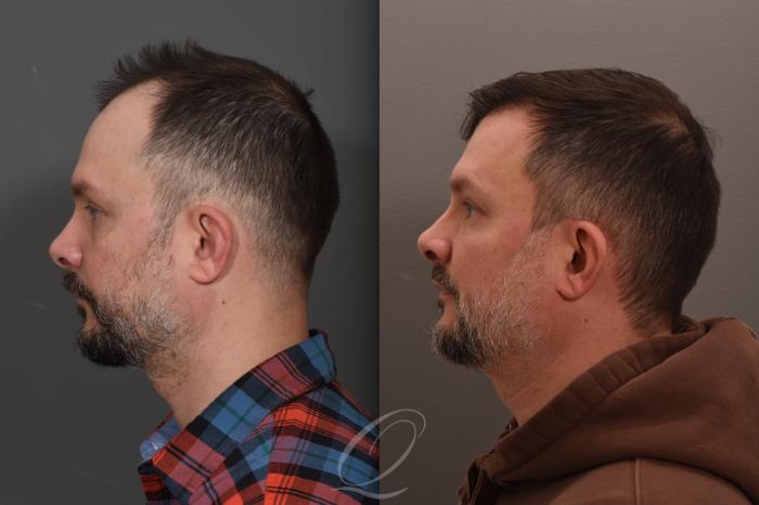 Male Hairline and Central Density Hair Restoration Case 1001686 Before & After Left Side | Serving Rochester, Syracuse & Buffalo, NY | Quatela Center for Plastic Surgery