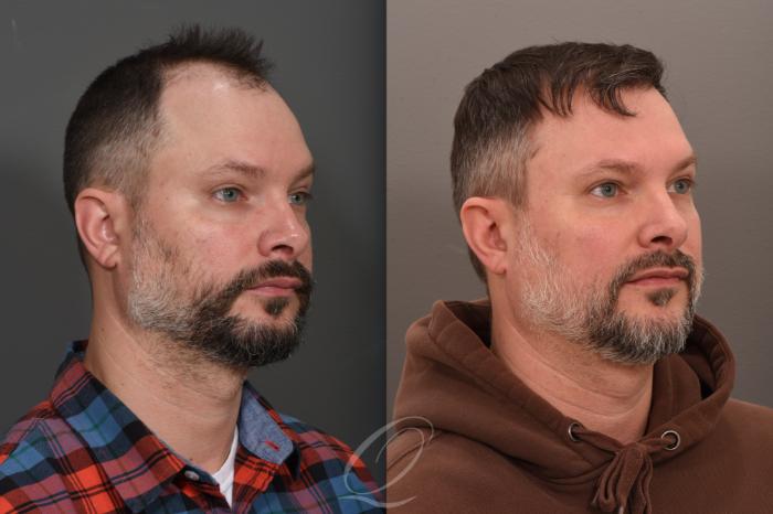 Before & After Male FUE Hair Transplant Case 1001686 Right Oblique View in Rochester, Buffalo, & Syracuse, NY