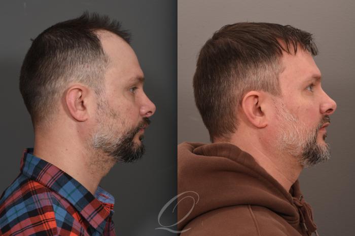 Before & After Male FUE Hair Transplant Case 1001686 Right Side View in Rochester, Buffalo, & Syracuse, NY