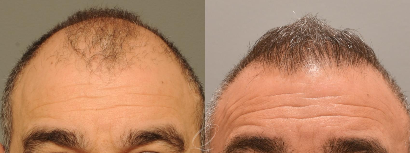 Before & After Male Hairline and Central Density Hair Restoration Case 1001688 Front View in Rochester, Buffalo, & Syracuse, NY
