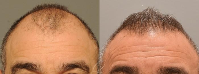 Before & After Male Hairline and Central Density Hair Restoration Case 1001688 Front View in Rochester, Buffalo, & Syracuse, NY