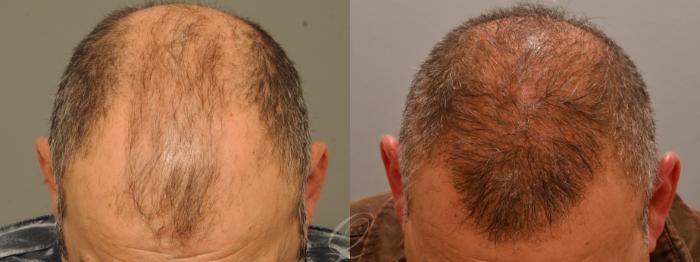 Male FUE Hair Transplant Case 1001688 Before & After Head down | Serving Rochester, Syracuse & Buffalo, NY | Quatela Center for Plastic Surgery